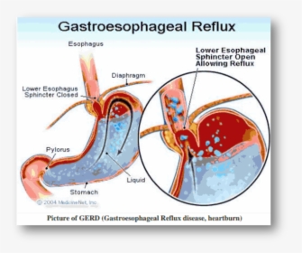 Reflux Oesophagitis Grade 2, HD Png Download, Free Download